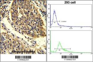(LEFT)Formalin-fixed and paraffin-embedded human lung carcinoma reacted with WNT4 Antibody (C-term), which was peroxidase-conjugated to the secondary antibody, followed by DAB staining. (WNT4 Antikörper  (C-Term))