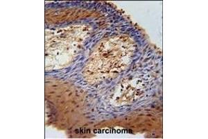 DHRS2 Antibody (C-term) (ABIN651532 and ABIN2840282) immunohistochemistry analysis in formalin fixed and paraffin embedded human skin carcinoma followed by peroxidase conjugation of the secondary antibody and DAB staining. (DHRS2 Antikörper  (C-Term))