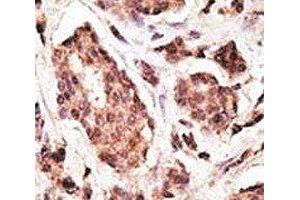 IHC analysis of FFPE human breast carcinoma tissue stained with the PGP9. (UCHL1 Antikörper  (AA 187-216))