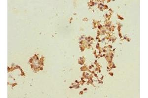 Immunohistochemistry of paraffin-embedded human breast cancer using ABIN7150598 at dilution of 1:100 (Ribophorin II Antikörper  (AA 360-540))