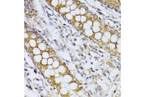 Immunohistochemistry of paraffin-embedded human colon using CCDC92 antibody (ABIN5974817) at dilution of 1/100 (40x lens). (CCDC92 Antikörper)