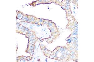 Immunohistochemistry of paraffin-embedded human liver cancer using CD47 antibody (ABIN6127604, ABIN6138199, ABIN6138201 and ABIN6223104) at dilution of 1:100 (40x lens). (CD47 Antikörper  (AA 20-140))