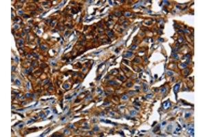 The image on the left is immunohistochemistry of paraffin-embedded Human lung cancer tissue using ABIN7189591(ABCC5 Antibody) at dilution 1/50, on the right is treated with synthetic peptide. (ABCC5 Antikörper)