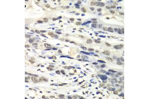 Immunohistochemistry of paraffin-embedded human gastric cancer using NUDT1 antibody. (NUDT1 Antikörper)