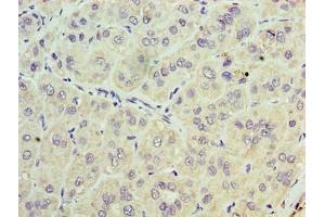 Immunohistochemistry of paraffin-embedded human liver cancer using ABIN7171285 at dilution of 1:100 (TRBC1 Antikörper  (AA 1-176))