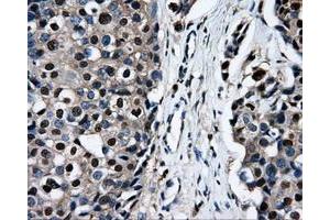 Immunohistochemical staining of paraffin-embedded Adenocarcinoma of ovary tissue using anti-RALBP1mouse monoclonal antibody. (RALBP1 Antikörper)