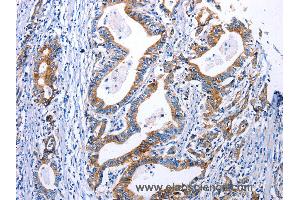 Immunohistochemistry of Human gastric cancer using DRD4 Polyclonal Antibody at dilution of 1:30 (DRD4 Antikörper)
