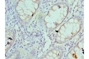 Immunohistochemistry of paraffin-embedded human colon cancer using ABIN7142558 at dilution of 1:100 (RPS4X Antikörper  (AA 66-263))