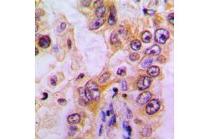 Immunohistochemical analysis of EHHADH staining in human liver cancer formalin fixed paraffin embedded tissue section. (EHHADH Antikörper  (Center))