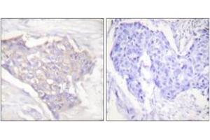Immunohistochemistry analysis of paraffin-embedded human breast carcinoma tissue, using BIM Antibody. (BIM Antikörper  (AA 1-50))