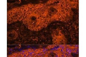 Immunofluorescence analysis of Human skin cancer using TYR Polyclonal Antibody at dilution of 1:100. (TYR Antikörper)