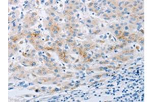 The image on the left is immunohistochemistry of paraffin-embedded Human liver cancer tissue using ABIN7191702(NPY2R Antibody) at dilution 1/20, on the right is treated with synthetic peptide. (NPY2R Antikörper)