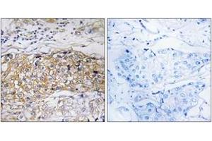 Immunohistochemistry analysis of paraffin-embedded human breast carcinoma tissue, using USP24 Antibody. (USP24 Antikörper  (AA 21-70))