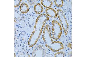 Immunohistochemistry of paraffin-embedded human kidney cancer using MAP2 Antibody. (MAP2 Antikörper)