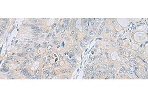 Immunohistochemistry of paraffin-embedded Human colorectal cancer tissue using APOBR Polyclonal Antibody at dilution of 1:35(x200) (APOBR Antikörper)