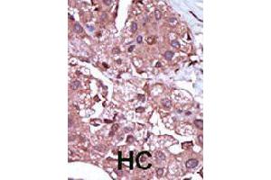 Formalin-fixed and paraffin-embedded human hepatocellular carcinoma tissue reacted with ACVRL1 polyclonal antibody  , which was peroxidase-conjugated to the secondary antibody, followed by DAB staining. (ACVRL1 Antikörper  (C-Term))
