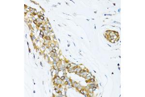 Immunohistochemistry of paraffin-embedded human breast cancer using DCTN2 antibody (ABIN5971226) at dilution of 1/100 (40x lens). (Dynamitin Antikörper)
