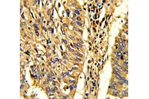 IHC analysis of FFPE human lung carcinoma with HSP60 antibody (HSPD1 Antikörper  (AA 80-109))