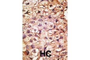 Formalin-fixed and paraffin-embedded human hepatocellular carcinoma tissue reacted with ACE2 polyclonal antibody  , which was peroxidase-conjugated to the secondary antibody, followed by AEC staining. (ACE2 Antikörper  (AA 59-90))