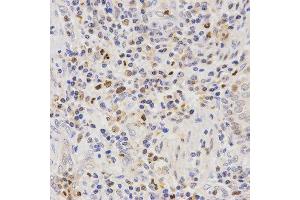 Immunohistochemistry of paraffin-embedded human lung cancer tissue using SCTR antibody at dilution of 1:200 (x400 lens) (SCTR Antikörper)