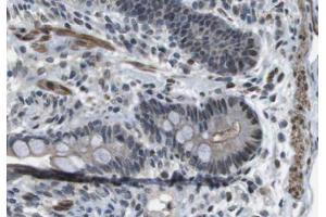 ABIN6266623 at 1/100 staining human colon carcinoma tissue sections by IHC-P. (Peripherin Antikörper  (C-Term))