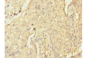 Immunohistochemistry of paraffin-embedded human lung cancer using ABIN7167625 at dilution of 1:100 (RGS Antikörper  (AA 230-350))