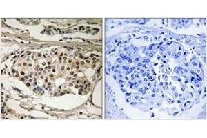 Immunohistochemistry analysis of paraffin-embedded human breast carcinoma, using NF-kappaB p65 (Phospho-Ser281) Antibody. (NF-kB p65 Antikörper  (pSer281))