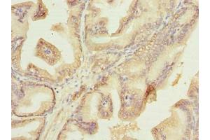 Immunohistochemistry of paraffin-embedded human prostate cancer using ABIN7177750 at dilution of 1:100 (Plet1 Antikörper  (AA 28-218))