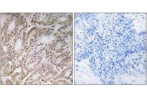 Immunohistochemistry analysis of paraffin-embedded human colon carcinoma tissue, using UBQLN4 Antibody. (UBQLN4 Antikörper  (AA 201-250))