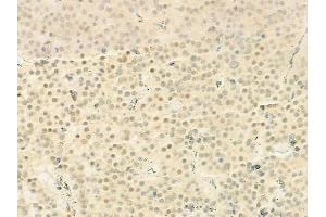 ABIN6260075 and ABIN6272255 at 1/100 staining human pituitary adenoma by IHC-P.