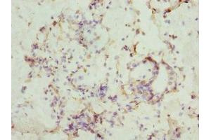 Immunohistochemistry of paraffin-embedded human breast cancer using ABIN7146874 at dilution of 1:100 (CSNK1G1 Antikörper  (Isoform gamma 1))