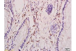 Formalin-fixed and paraffin embedded human colon carcinoma tissue labeled with Anti CIP2A/p90 Autoantigen Polyclonal Antibody,Unconjugated (ABIN760241) at 1:200 followed by conjugation to the secondary antibody and DAB staining.