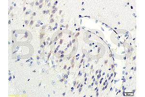 Formalin-fixed and paraffin-embedded human colon carcinoma labeled with Rabbit Anti-GRB2/ASH Polyclonal Antibody (ABIN686932) , Unconjugated 1:200 followed by conjugation to the secondary antibody and DAB staining (GRB2 Antikörper)