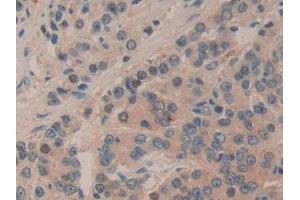 Detection of mTOR in Human Prostate cancer Tissue using Polyclonal Antibody to Serine/threonine-protein kinase mTOR (mTOR) (MTOR Antikörper  (AA 2226-2488))