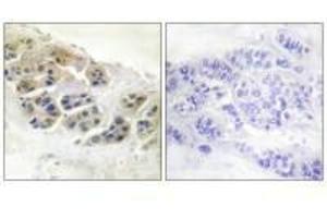 Immunohistochemistry analysis of paraffin-embedded human breast carcinoma tissue using Mammaglobin antibody. (Mammaglobin A Antikörper)