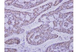 IHC-P Image CaMK1D antibody detects CAMK1D protein at nucleus on human breast cancer by immunohistochemical analysis. (CAMK1D Antikörper)