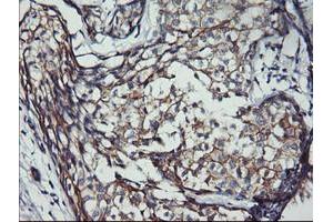 Immunohistochemical staining of paraffin-embedded Adenocarcinoma of Human breast tissue using anti-ERBB2 mouse monoclonal antibody. (ErbB2/Her2 Antikörper  (AA 676-1255))