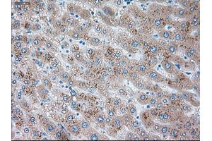 Immunohistochemical staining of paraffin-embedded Carcinoma of liver tissue using anti-SERPINA1mouse monoclonal antibody. (SERPINA1 Antikörper)