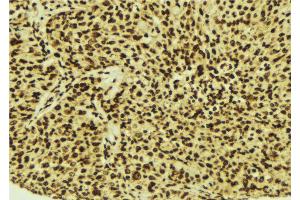 ABIN6274515 at 1/100 staining Human breast cancer tissue by IHC-P. (LASS4 Antikörper  (N-Term))