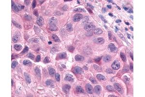 Anti-ESRRA / ERR Alpha antibody IHC of human Lung, Non-Small Cell Carcinoma. (ESRRA Antikörper  (Internal Region))