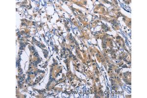 Immunohistochemistry of Human colon cancer using SYT17 Polyclonal Antibody at dilution of 1:60 (SYT17 Antikörper)