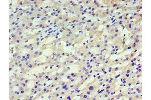 Immunohistochemistry of paraffin-embedded human liver cancer using ABIN7155257 at dilution of 1:100 (HARS1/Jo-1 Antikörper  (AA 1-180))