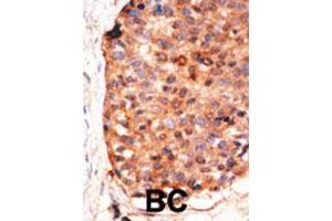 Formalin-fixed and paraffin-embedded human cancer tissue reacted with the APOBEC3G polyclonal antibody  , which was peroxidase-conjugated to the secondary antibody, followed by DAB staining. (APOBEC3G Antikörper  (C-Term))