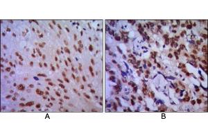 Immunohistochemical analysis of paraffin-embedded human lung cancer (A) and esophageal cancer (B), showing cytoplasmic localization using CDC2 mouse mAb with DAB staining. (CDK1 Antikörper)
