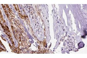 ABIN6267132 at 1/100 staining Human thyroid cancer tissue by IHC-P.