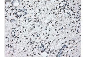 Immunohistochemical staining of paraffin-embedded Adenocarcinoma of breast tissue using anti-BRAF mouse monoclonal antibody. (BRAF Antikörper)