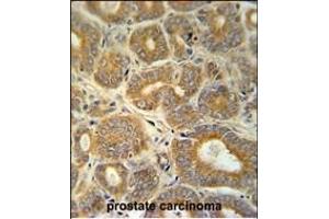 CRABP1 Antibody (C-term) (ABIN651614 and ABIN2840325) immunohistochemistry analysis in formalin fixed and paraffin embedded human prostate carcinoma followed by peroxidase conjugation of the secondary antibody and DAB staining. (CRABP1 Antikörper  (C-Term))