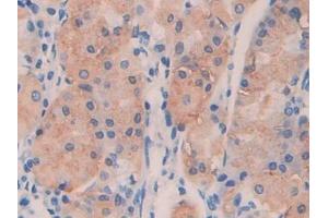 IHC-P analysis of Human Stomach cancer Tissue, with DAB staining. (ANGPTL4 Antikörper  (AA 182-388))