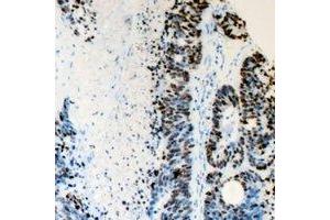 Immunohistochemical analysis of FANCD2 staining in human colon cancer formalin fixed paraffin embedded tissue section. (FANCD2 Antikörper  (N-Term))
