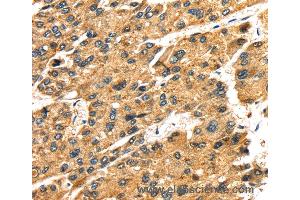 Immunohistochemistry of Human liver cancer using SLC25A26 Polyclonal Antibody at dilution of 1:30 (SLC25A26 Antikörper)